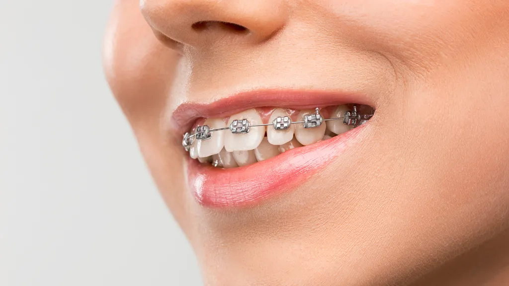 Fixed braces close-up